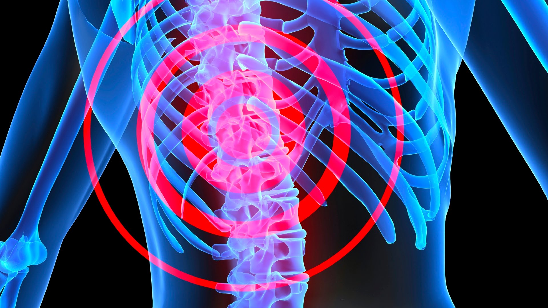 Spinal Cord Injury