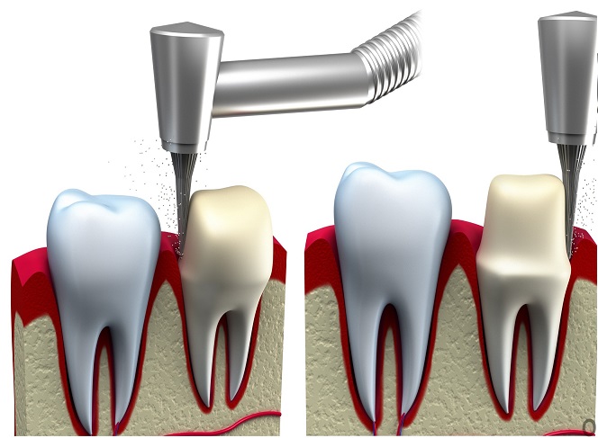 dental crown